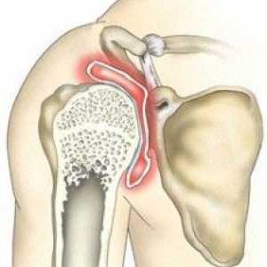 Osteoartritis ramenog zgloba