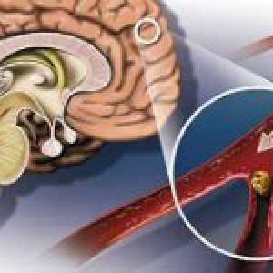 Ateroskleroze moždanih žila i njegovih simptoma