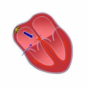 AV blok (AV) srca: uzroci, opseg, simptomi, dijagnoza, liječenje