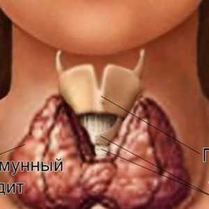 Autoimune bolesti ženskog štitne žlijezde: znakovi razaranja i liječenje tireoiditis