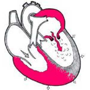 Aortalni insuficijencija ventil i njegovo liječenje
