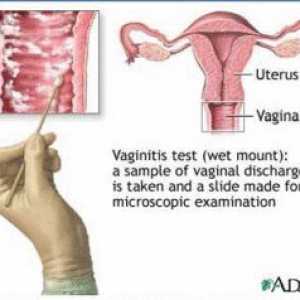 Bakterijska vaginoza (coleitis) - simptomi, dijagnostiku i liječenje metode