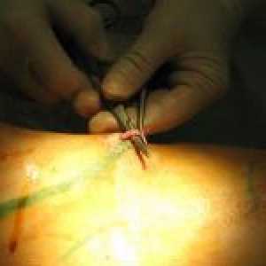 Kirurško liječenje proširenih vena na nogama