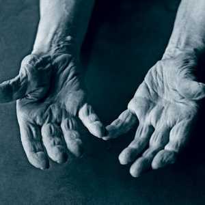 Bolan zglobovi prstiju: liječenje i prevencija
