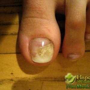 Brzo reljef iz narodnih lijekova noktiju gljiva