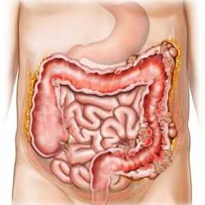 Liječenje i dijeta za diverticulosis debelog crijeva