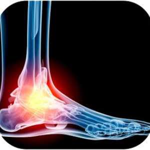 Što učiniti s osteoartritisom stopala?