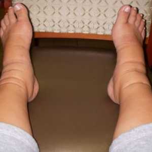 Što učiniti s edem noge nakon poroda