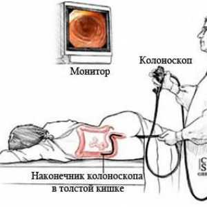 Dijagnostički postupak je kolonoskopija crijeva