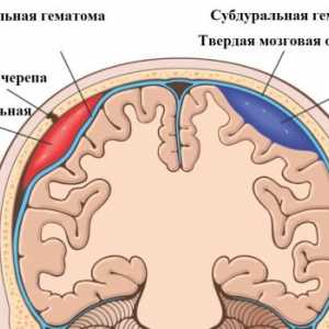 Simptomi i liječenje epiduralni hematom na mozgu