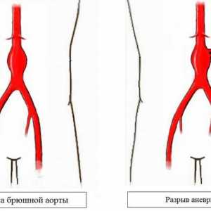 Što je aneurizma abdominalne aorte?