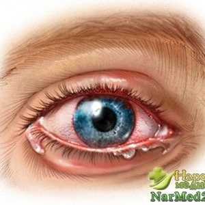 Što je iridociklitis oči i kako se nositi s bolešću