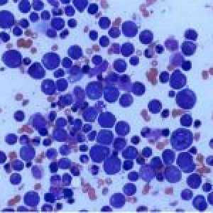 Leukocitoza (povišeni bijelih krvnih stanica u krvi): norma ili patologije?