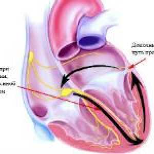 Što sindrom prerano ventrikularne