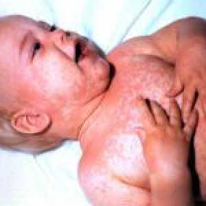 Značajke vaskulitisa u djece