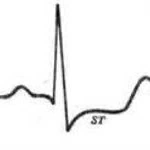 EKG znakovi srčanog angina