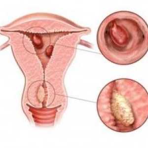 Što je glandulocystica hiperplazija endometrija