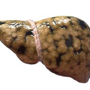 Što je steatoza jetre?