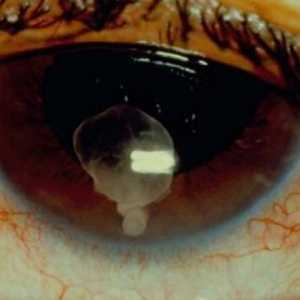 Cisticerkoza očiju: uzroci, simptomi, liječenje