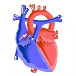 Fibrilacija septuma defekt srca u djece i odraslih: uzroci, simptomi, kako se postupa