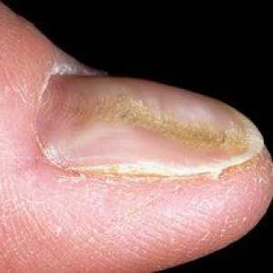 Deformacija noktiju. Uzroci, simptomi, liječenje