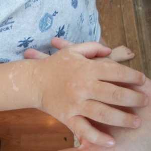 Dijete bolest karakterizirana bijele točke