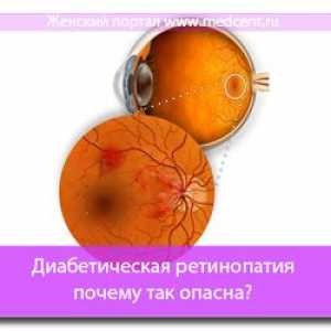 Dijabetička retinopatija - zašto je tako opasno?