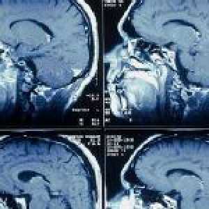 Dijagnostičke mogućnosti plovila MRI mozga