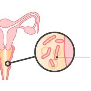 Dijagnoza i liječenje bakterijske vaginoze (bakterijska vaginoza)
