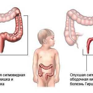 Dijagnoza i liječenje djeteta dolihosigmoy