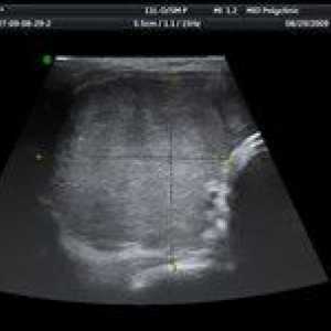 Zašto ultrazvuk štitnjače i to pokazuje