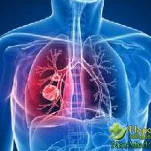 Početna liječenju bronhitisa narodnih lijekova