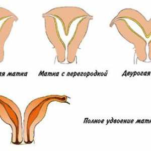 Dvije rogova maternice: struktura anomalija genitalije
