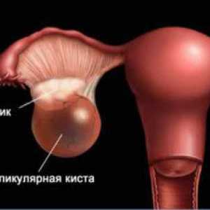 Folikularne Ciste jajnika: Simptomi, dijagnoza i liječenje trudnoća