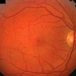 Pozadina retinopatija oka