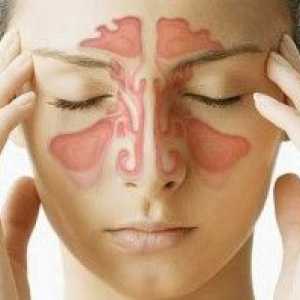 Sinusitis: simptomi, uzroci i liječenje