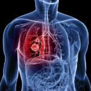 Simptomi plućne krvarenja i prva pomoć