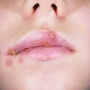 Herpes na usnama u djece