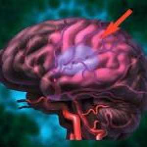Opasna sužavanje krvnih žila u glavi, i kako da biste dobili osloboditi od njega