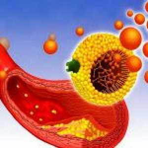 Hiperkolesterolemija i njeno liječenje