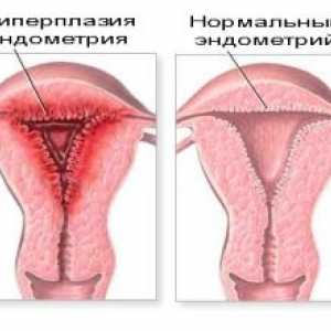 Hiperplazija endometrija: liječenje lijekovima i narodnih lijekova