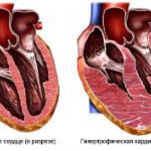 Hipertrofična kardiomiopatija u djece i odraslih