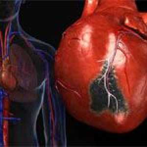 Glavni razlozi za opsežne infarkta miokarda