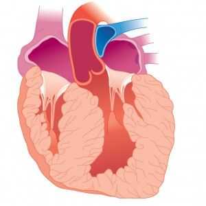 Hipertrofija ventrikula miokarda, fibrilacija: simptomi, uzroci, liječenje, lokalizacija