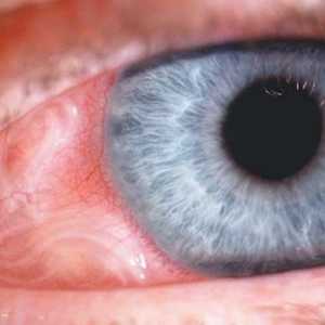Očni toxocariasis: simptomi, dijagnoza, liječenje