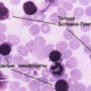 Kronična leukemija krv