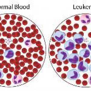Kako liječiti leukemiju krvi