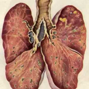 Razdoblje inkubacije tuberkuloze, njegove dijagnostici i liječenju