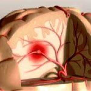 Glavni simptomi moždanog udara