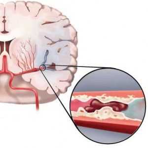 Ishemijski moždani udar: uzroci, simptomi, prva pomoć, liječenje, komplikacije, prognoza